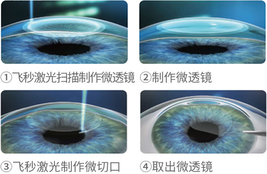 全飛秒激光近視手術